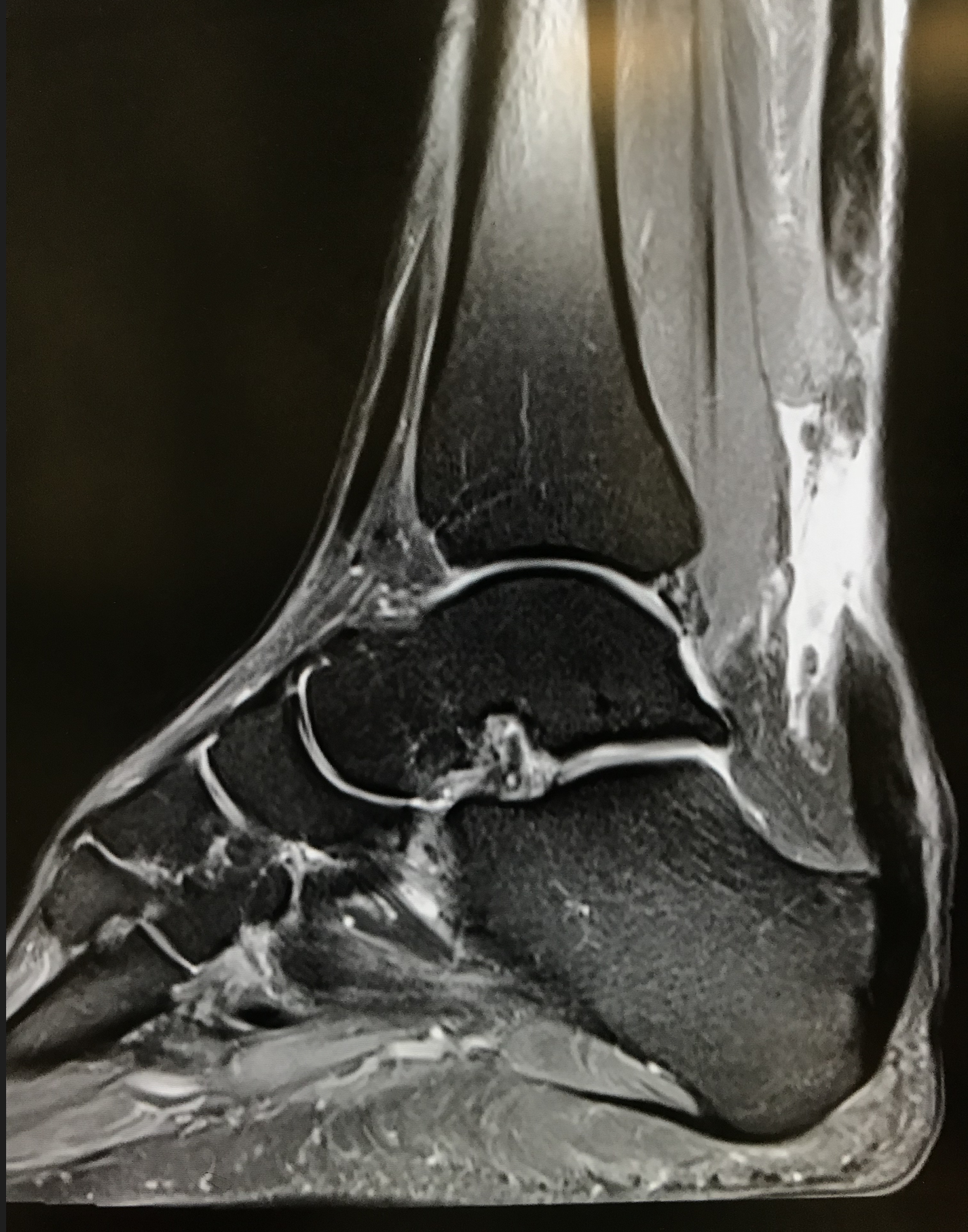 Achilles Tendon Rupture & Reconstruction | David Redfern Surgery